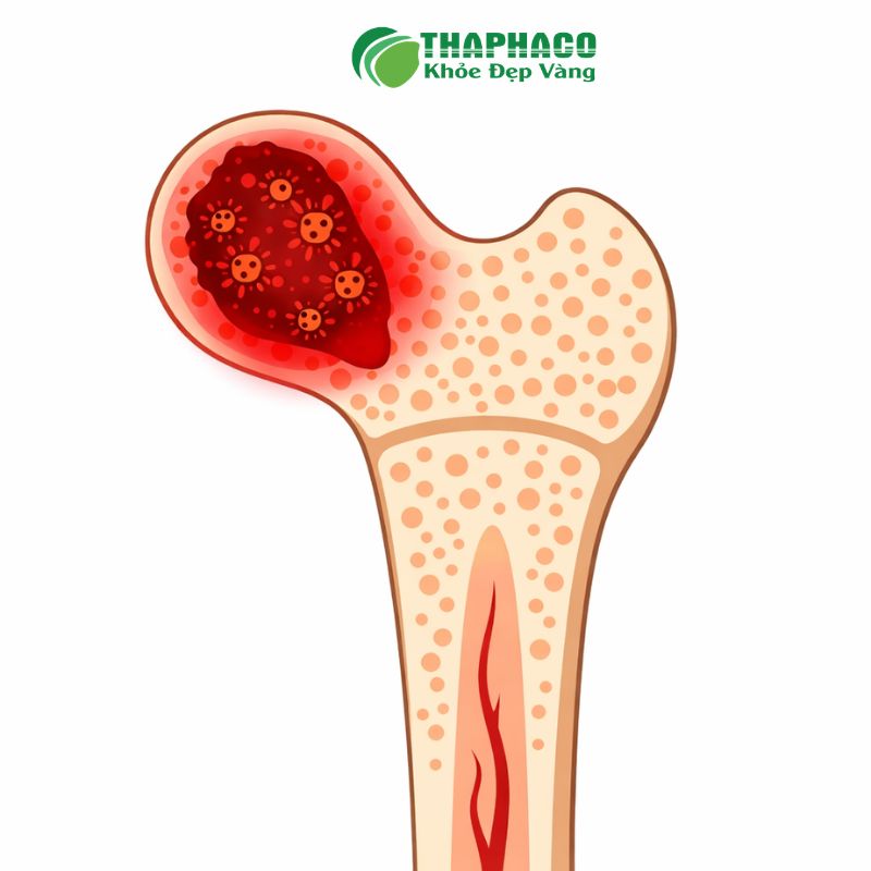 thâm nhiễm tuỷ xương là bệnh gì