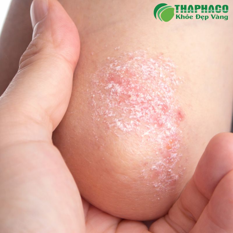Vảy nến là bệnh viêm da mạn tính do rối loạn hệ miễn dịch, khiến tế bào da phát triển quá nhanh