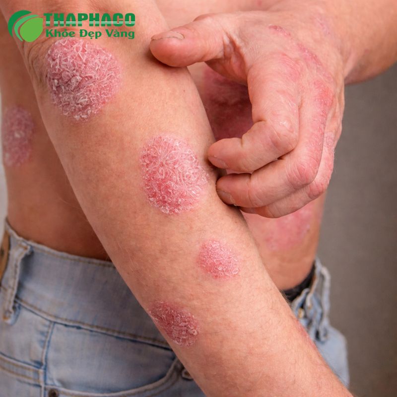 Nếu không được kiểm soát, vảy nến có thể dẫn đến viêm khớp vảy nến