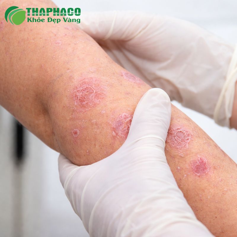 Bạn nên tìm đến bác sĩ da liễu khi vảy nến lan rộng, triệu chứng trở nặng