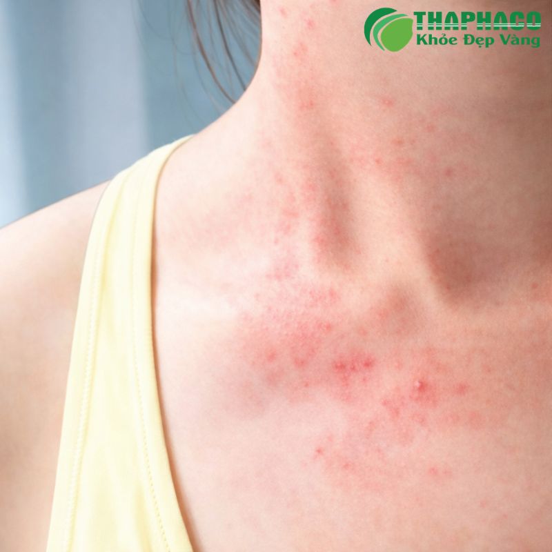 Các triệu chứng của viêm da cơ địa thể nặng thường rất rõ ràng và gây khó chịu