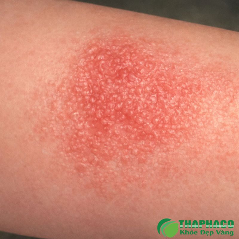 Viêm da dị ứng, hay còn gọi là chàm thể tạng (eczema), là một bệnh viêm da mãn tính