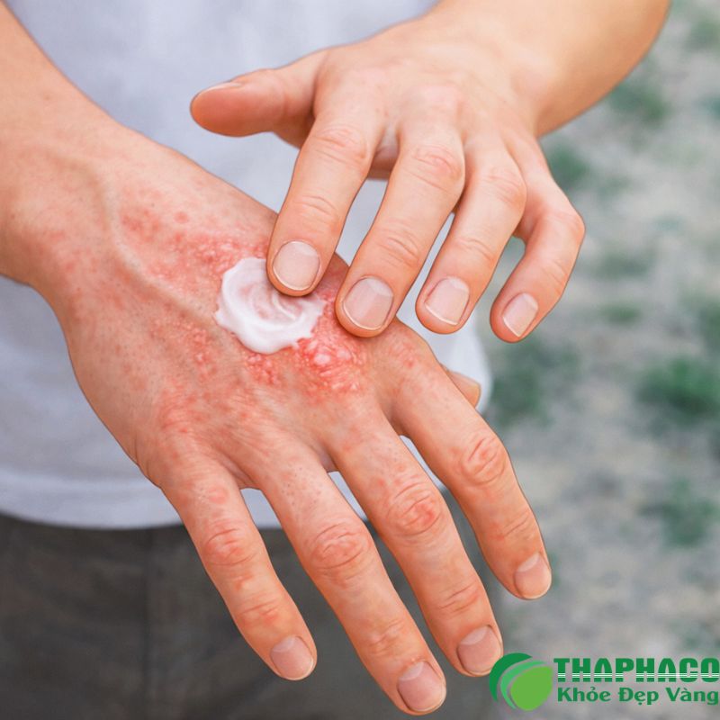 Phòng ngừa viêm da tiếp xúc là biện pháp hiệu quả nhất để giữ làn da khỏe mạnh