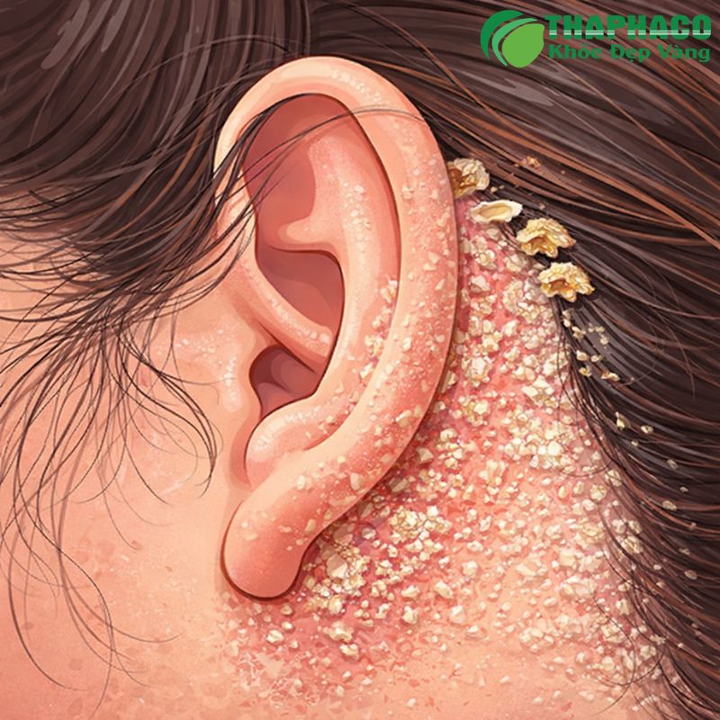 Triệu chứng viêm da tiết bã biểu hiện khác nhau tùy vùng da, từ gàu dai dẳng trên da đầu đến mảng đỏ