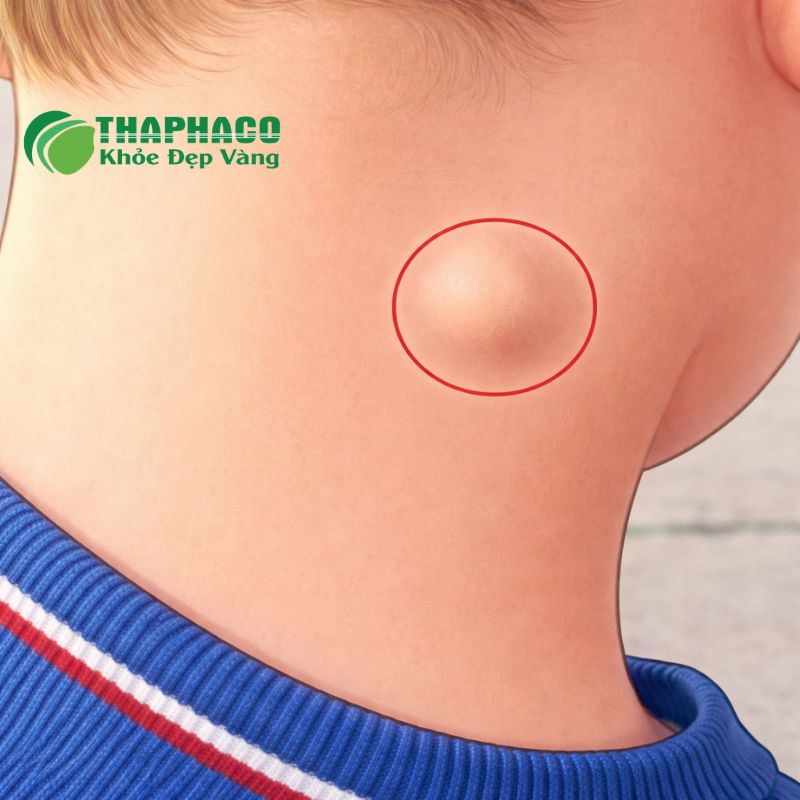 Viêm hạch bạch huyết do nhiều nguyên nhân, chủ yếu là nhiễm trùng từ vi khuẩn, virus, nấm
