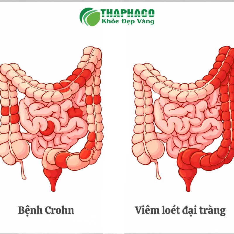 Cần phân biệt giữa bệnh Crohn và viêm loét đại tràng