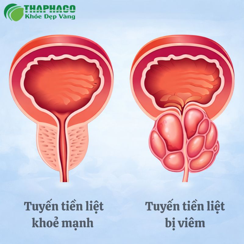 Viêm tuyến tiền liệt là tình trạng viêm nhiễm hoặc sưng tấy tuyến tiền liệt