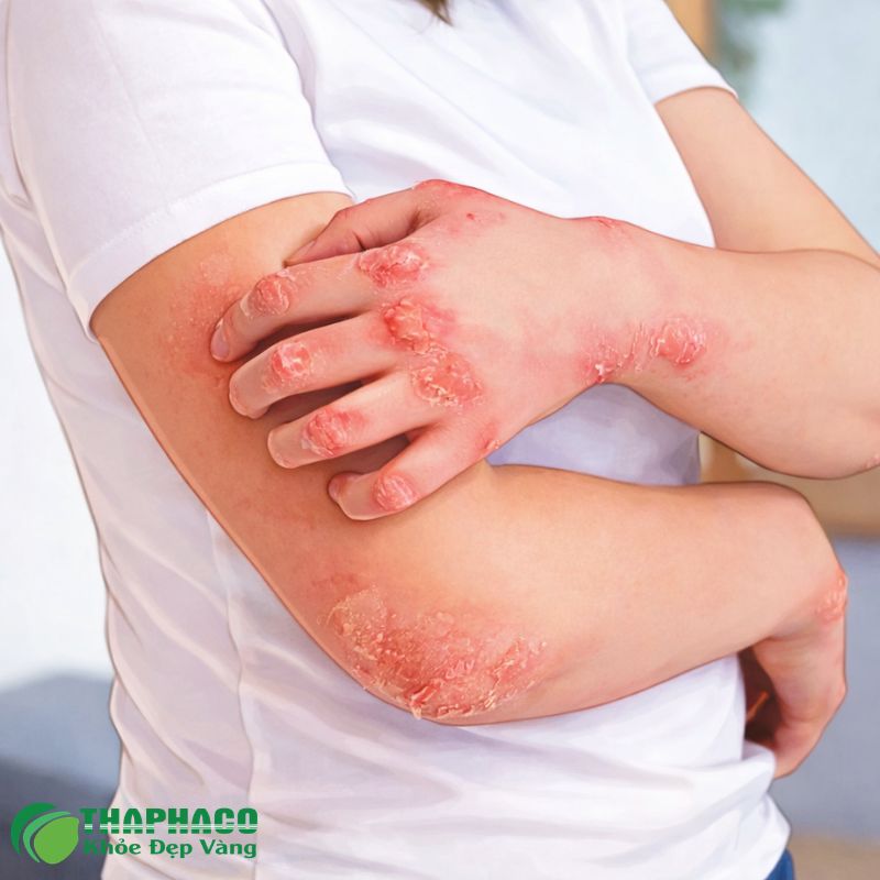 Xơ tủy xương là một bệnh ung thư máu hiếm gặp, nơi mô sẹo xơ tích tụ trong tủy xương