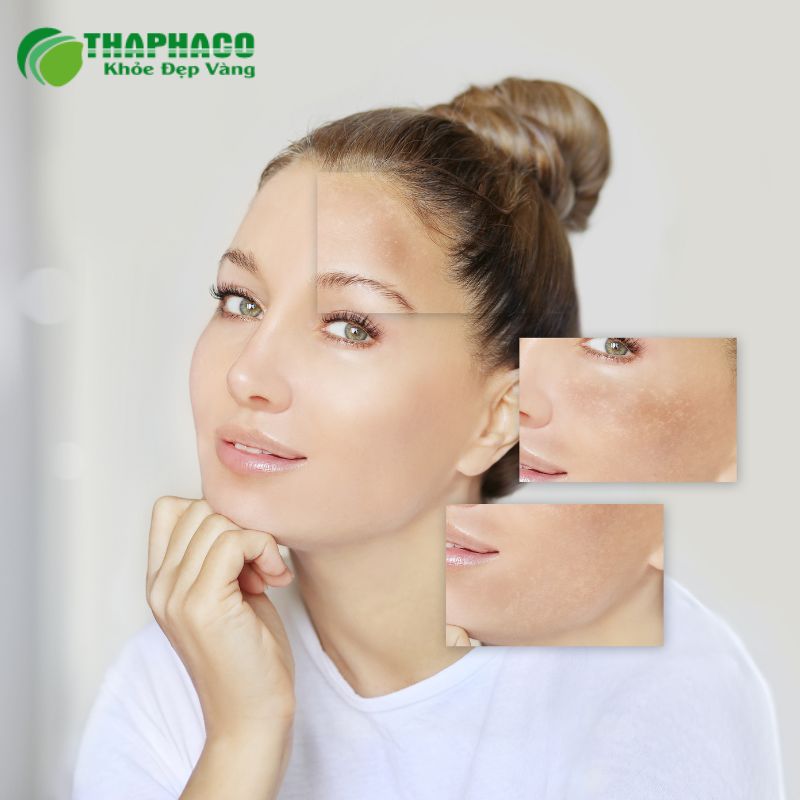 Nhận biết các triệu chứng điển hình của bệnh Addison như mệt mỏi, sụt cân, huyết áp thấp và sạm da