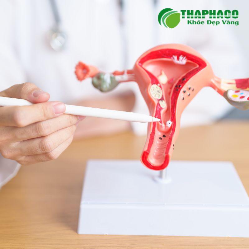 Nguyên nhân hình thành Polyp Cổ Tử Cung