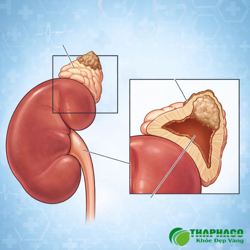 U tuỷ thượng thận là một loại khối u hiếm gặp, thường lành tính, phát triển từ tủy thượng thận