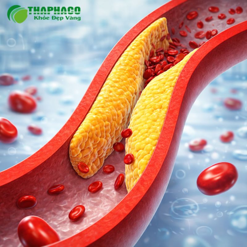 Rối loạn chuyển hóa lipid là một yếu tố nguy cơ hàng đầu cho các bệnh lý tim mạch