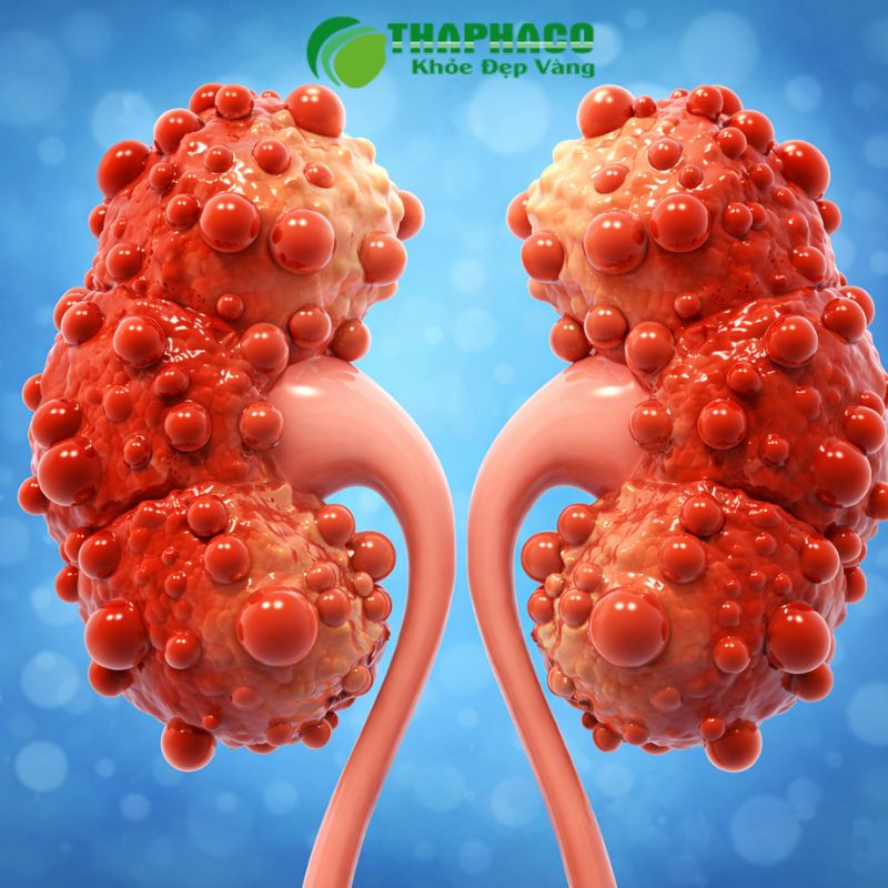 Chẩn đoán thận đa nang dựa trên siêu âm, CT, MRI và xét nghiệm máu/nước tiểu