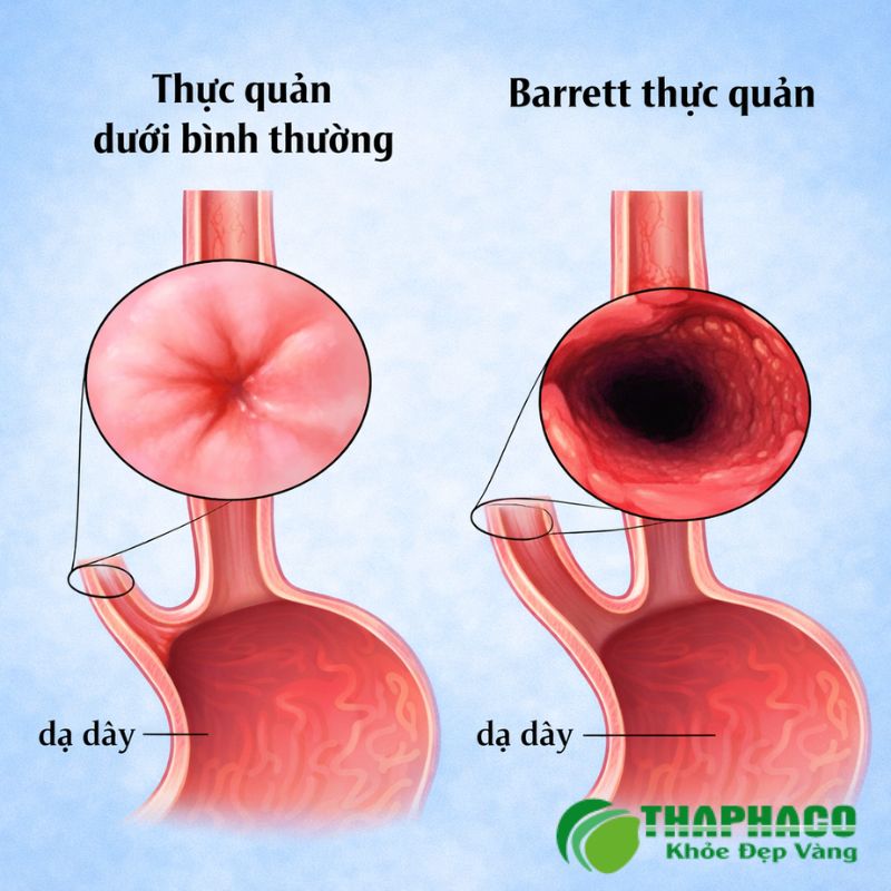 barrett thực quản là bệnh gì