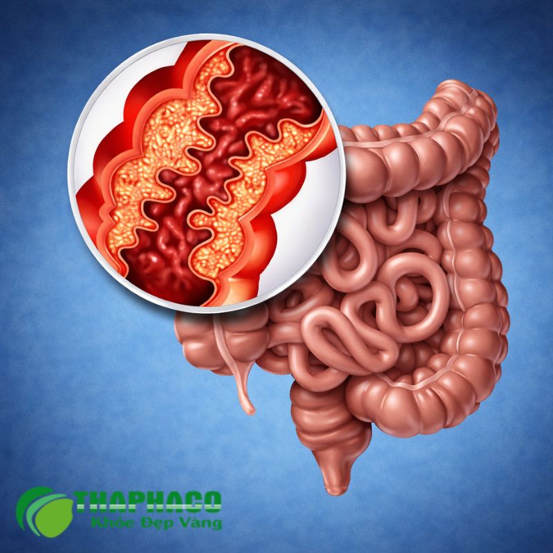 bệnh crohn là gì