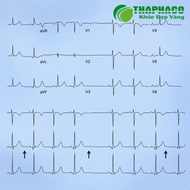 Block nhĩ thất được chia thành ba cấp độ: độ 1 (nhẹ nhất), độ 2 (Mobitz I và Mobitz II) và độ 3 (hoàn toàn)