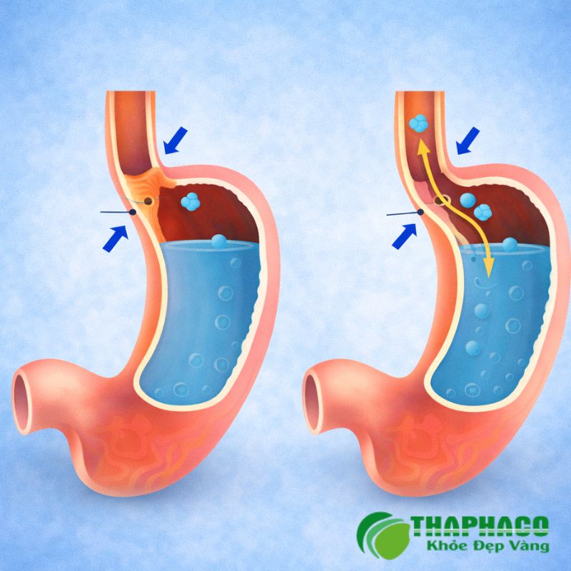 co thắt tâm vị là gì