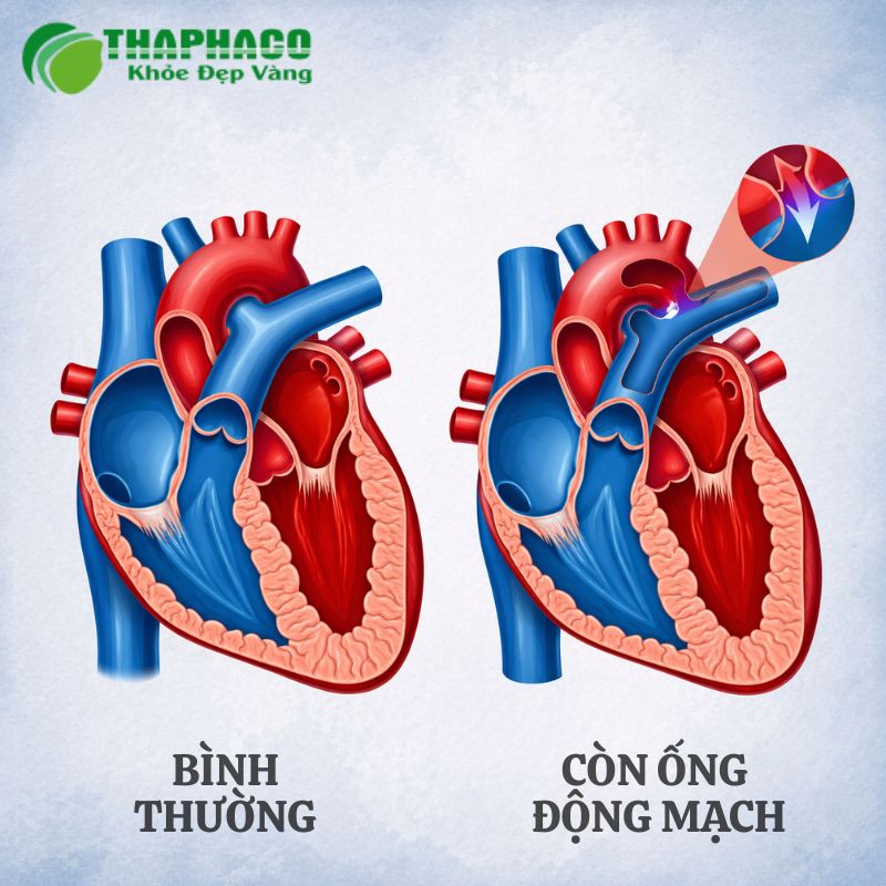 còn ống động mạch là gì