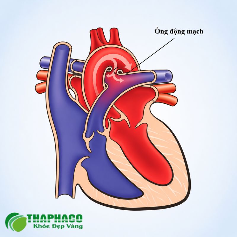Còn ống động mạch (PDA) là khi nó không đóng, gây lưu thông máu bất thường và áp lực lên tim, phổi