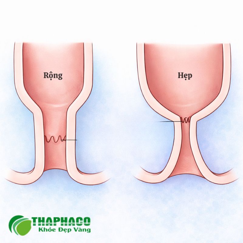 hẹp hậu môn là gì