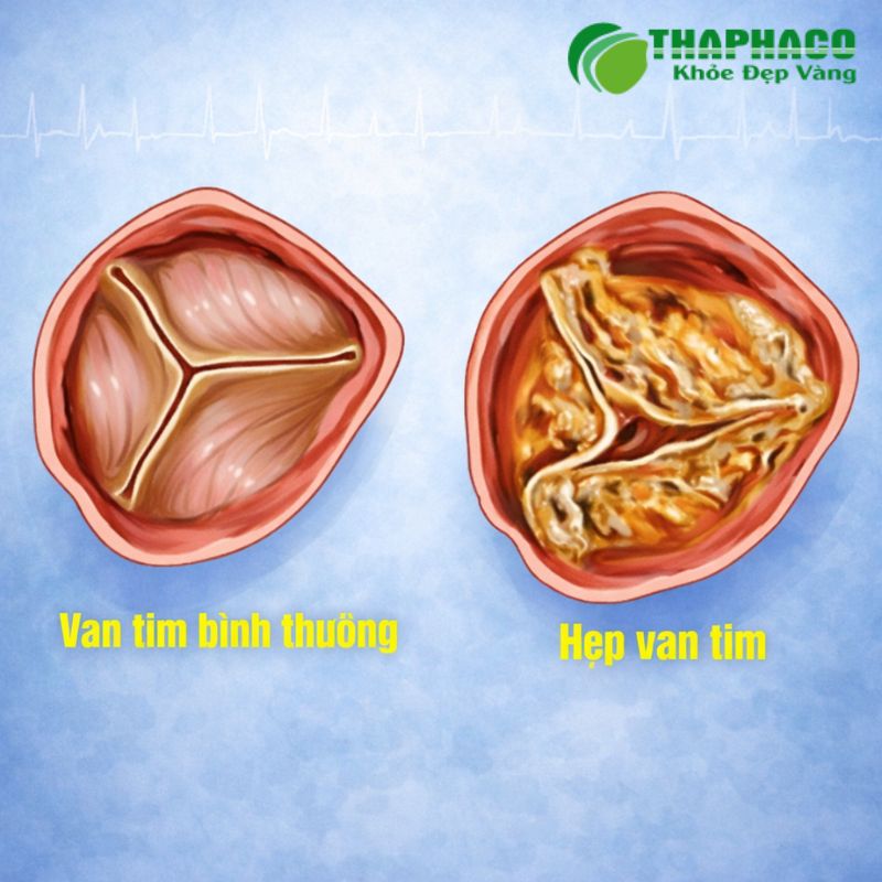 hẹp van tim là gì