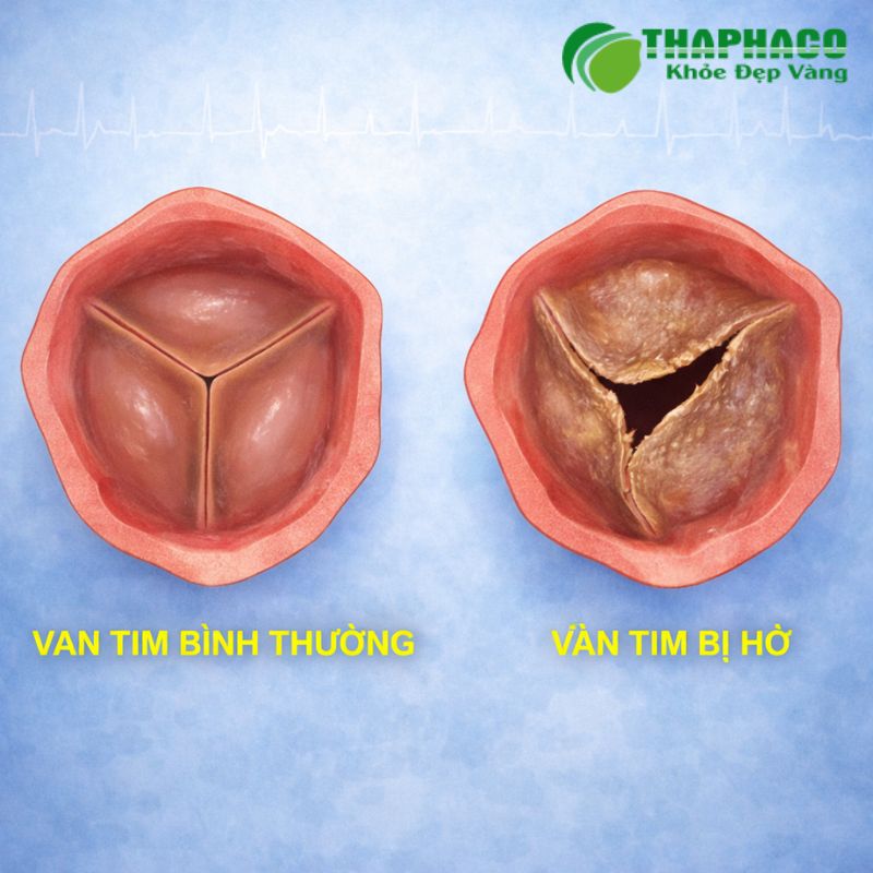 Hở van tim là tình trạng một hoặc nhiều van tim không đóng kín hoàn toàn, khiến máu trào ngược