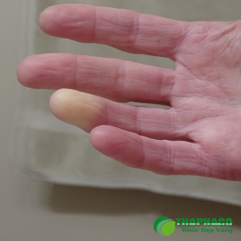 Hội chứng Raynaud là tình trạng co thắt mạch máu nhỏ bất thường, thường ở ngón tay, ngón chân