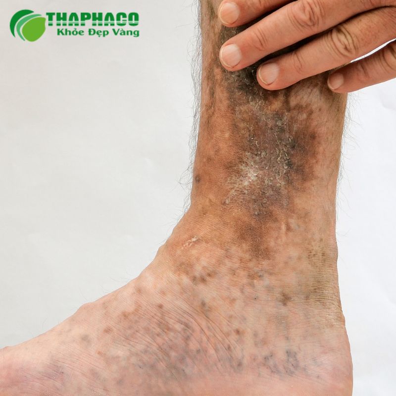 huyết khối tĩnh mạch sâu là gì