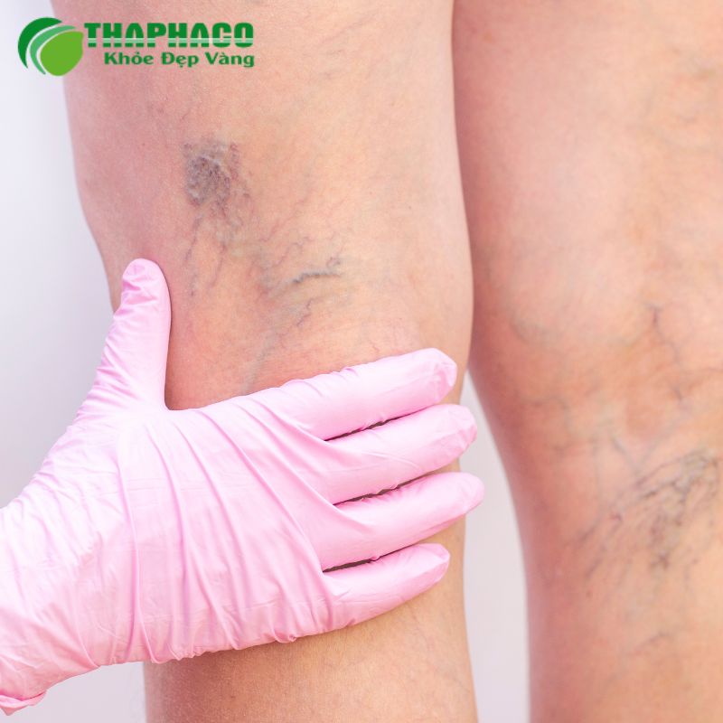 Huyết khối tĩnh mạch sâu (DVT) là tình trạng cục máu đông hình thành trong các tĩnh mạch sâu