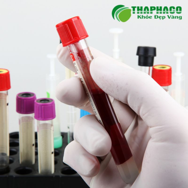 Chẩn đoán HP bao gồm test hơi thở, nội soi, xét nghiệm phân và máu