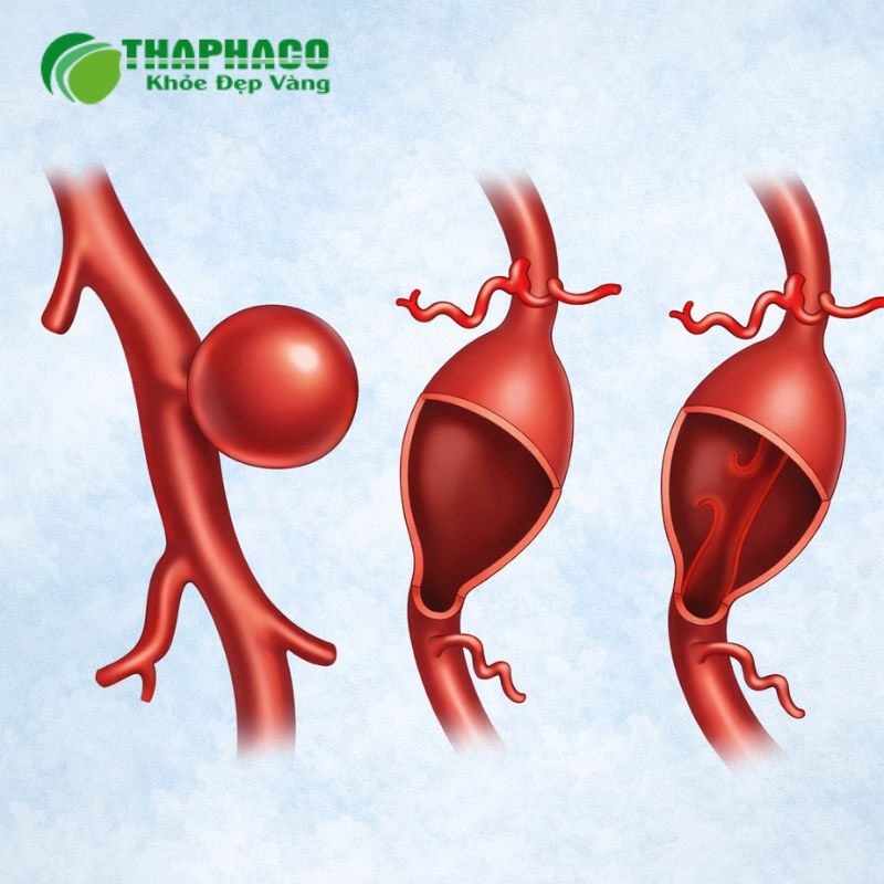 Phình động mạch thường bắt đầu khi lớp giữa của thành động mạch bị tổn thương hoặc suy yếu