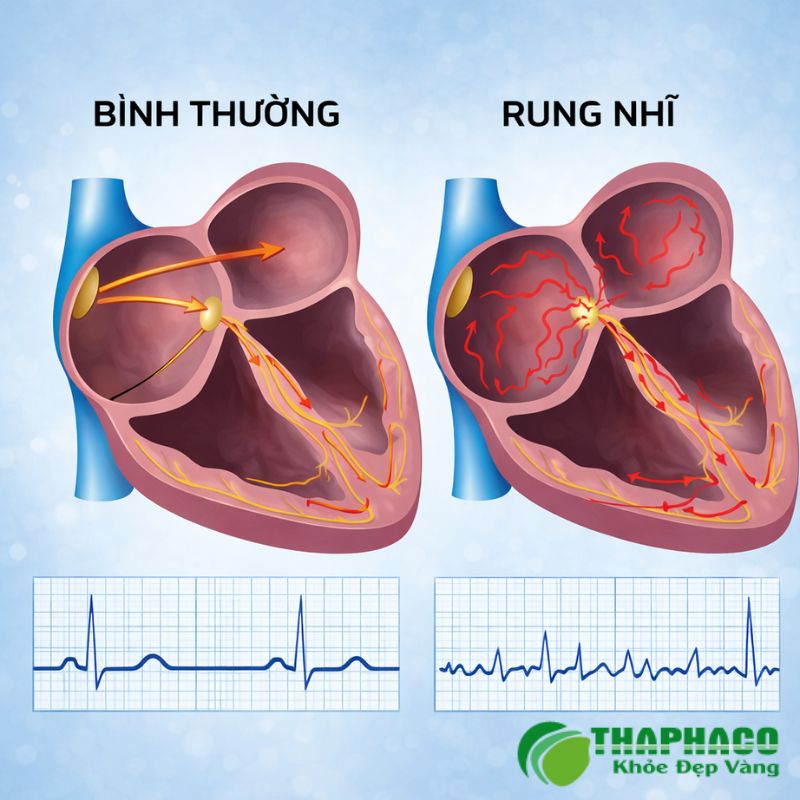 rung nhĩ là gì