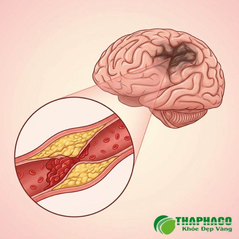 Nguyên nhân gây tai biến mạch máu não gồm có tăng huyết áp, tiểu đường, mỡ máu cao, bệnh tim mạch