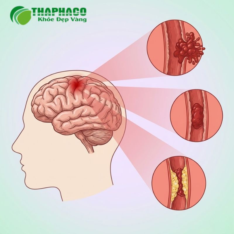 Tai biến mạch máu não để lại nhiều biến chứng nặng nề, ảnh hưởng sâu sắc đến chất lượng cuộc sống