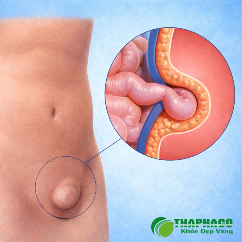 thoát vị bẹn là bệnh gì