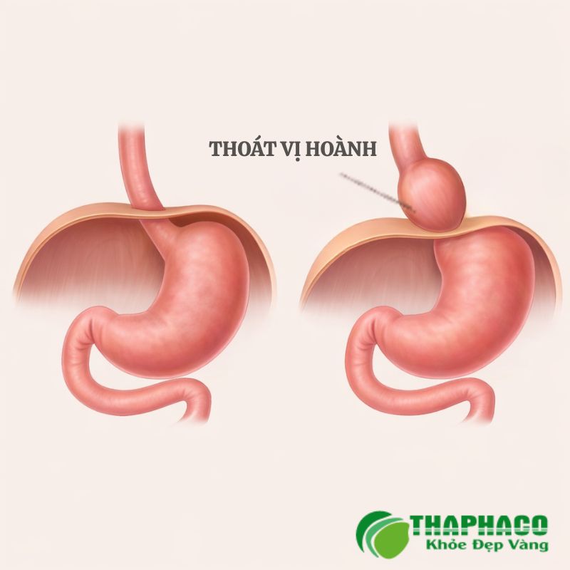 thoát vị hoành là bệnh gì