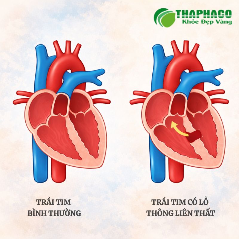 thông liên thất là bệnh gì