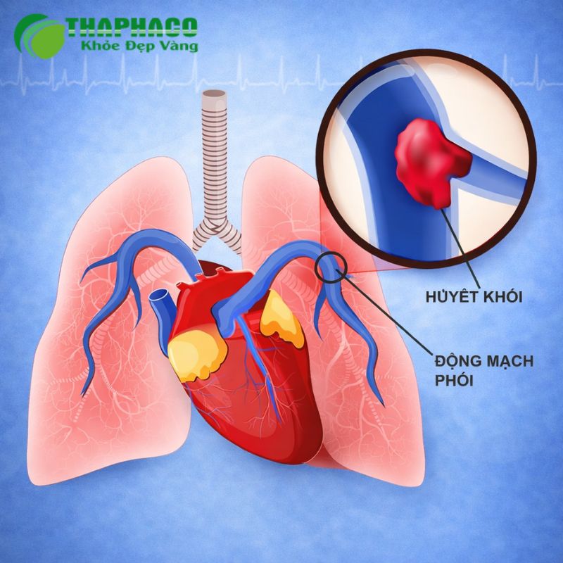 thuyên tắc phổi là gì