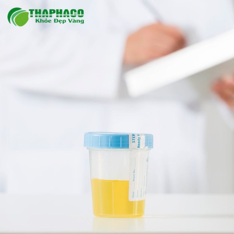 Các xét nghiệm cần thiết để chẩn đoán protein niệuCác xét nghiệm cần thiết để chẩn đoán protein niệu
