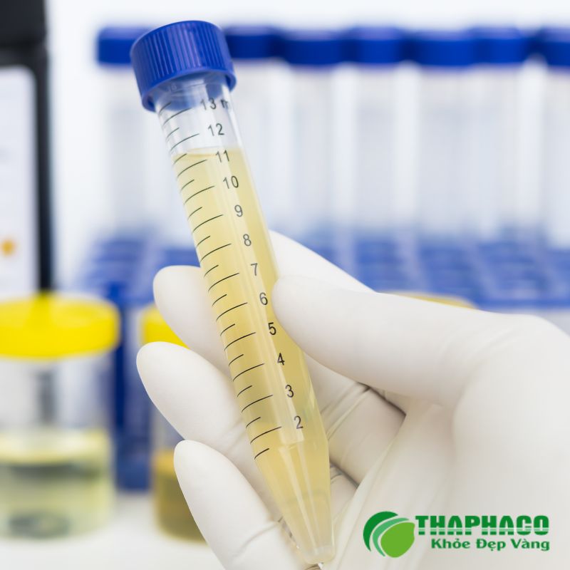 Phương Pháp Chẩn Đoán Và Điều Trị Tiểu Ra Mủ Hiệu Quả