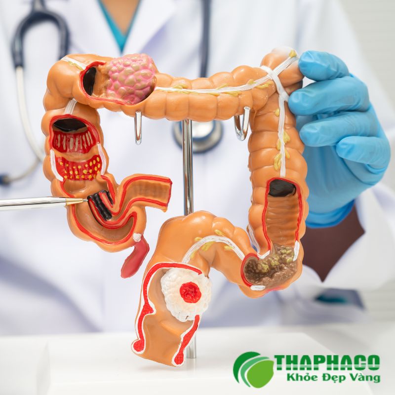 viêm đại tràng là bệnh gì