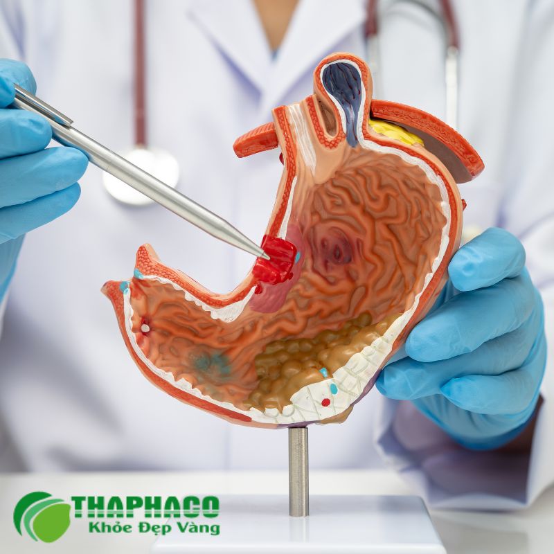 Viêm loét dạ dày là tình trạng niêm mạc dạ dày bị tổn thương, hình thành các vết loét
