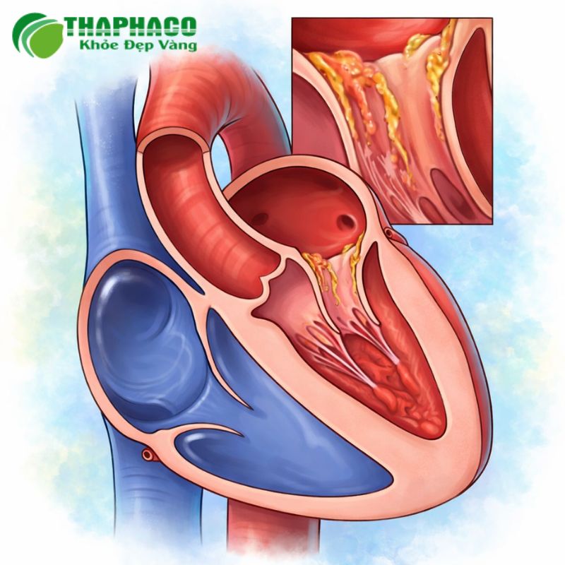 Viêm nội tâm mạc là tình trạng viêm nhiễm lớp màng trong cùng của tim