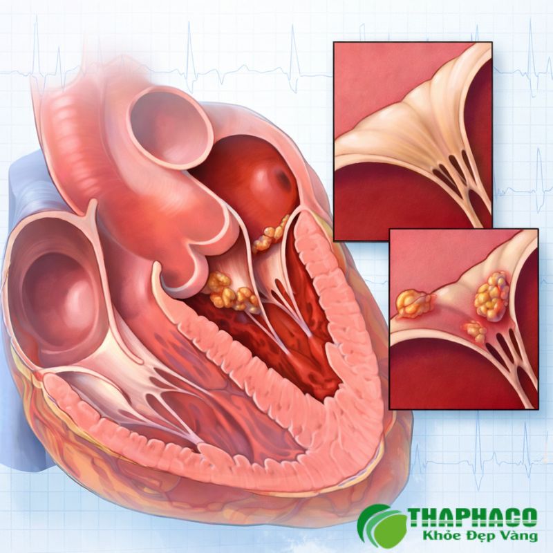 viêm nội tâm mạc là gì