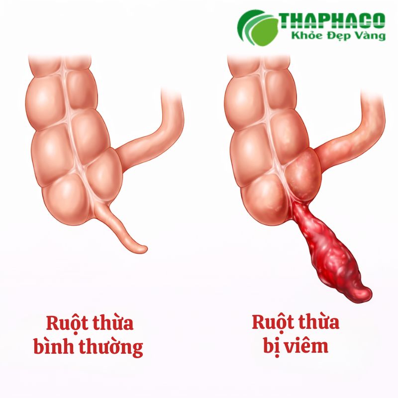 Viêm ruột thừa là tình trạng cấp tính của ruột thừa, một túi nhỏ nhô ra từ ruột già