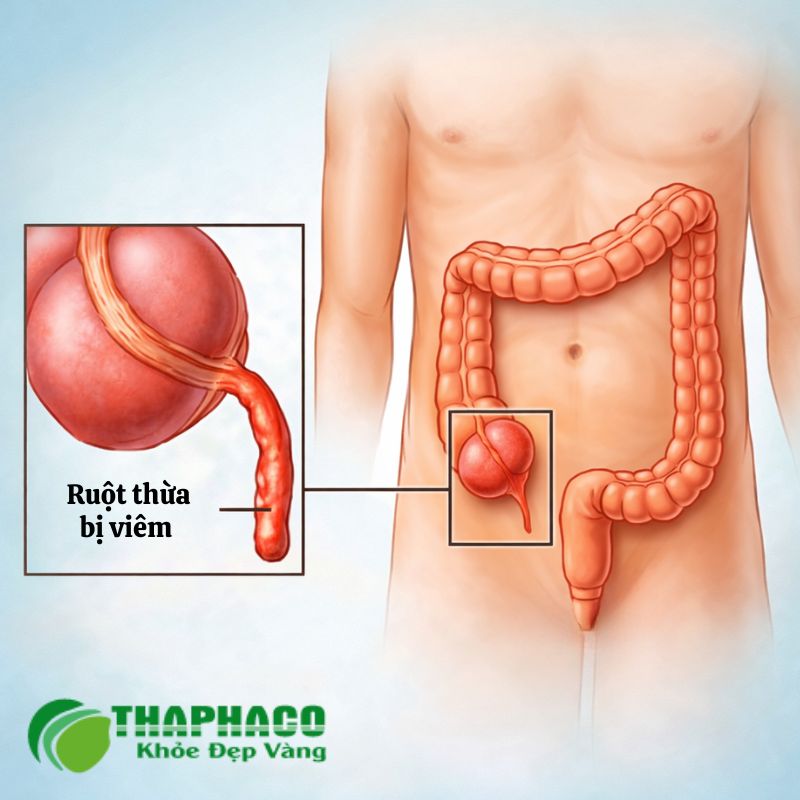 viêm ruột thừa là gì