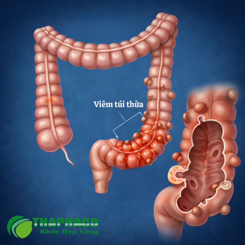 viêm túi thừa là gì