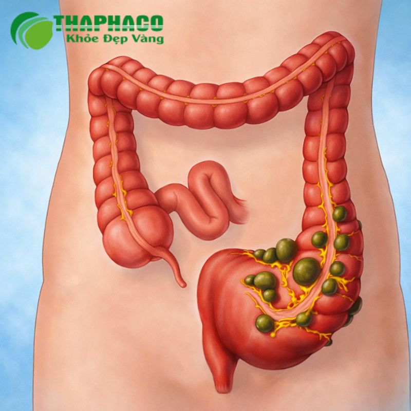 Viêm túi thừa không được điều trị kịp thời có thể dẫn đến các biến chứng nghiêm trọng